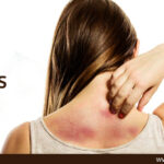 skin rashes