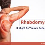 Rhabdomyolysis-Causes-Prevention
