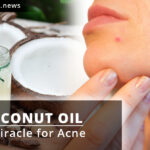Coconut oil - A Miracle For Acne.
