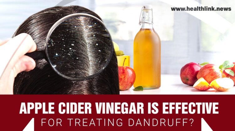 Apple Cider Vinegar-Dandruff