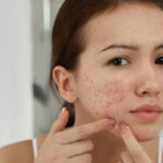 Foods that Causes of Acne
