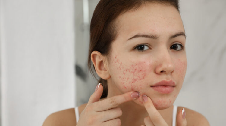 Foods that Causes of Acne