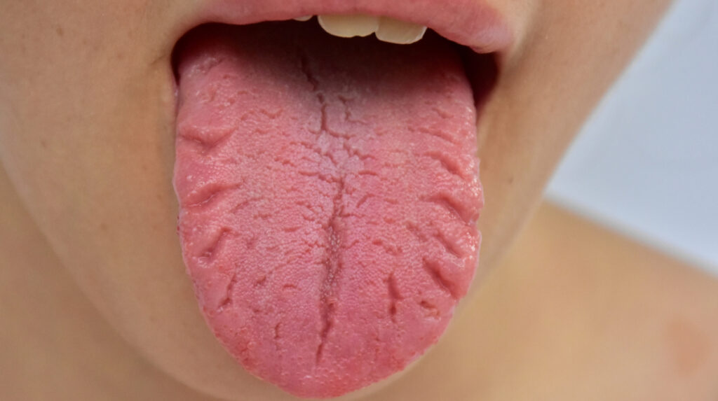 Fissure on Tongue