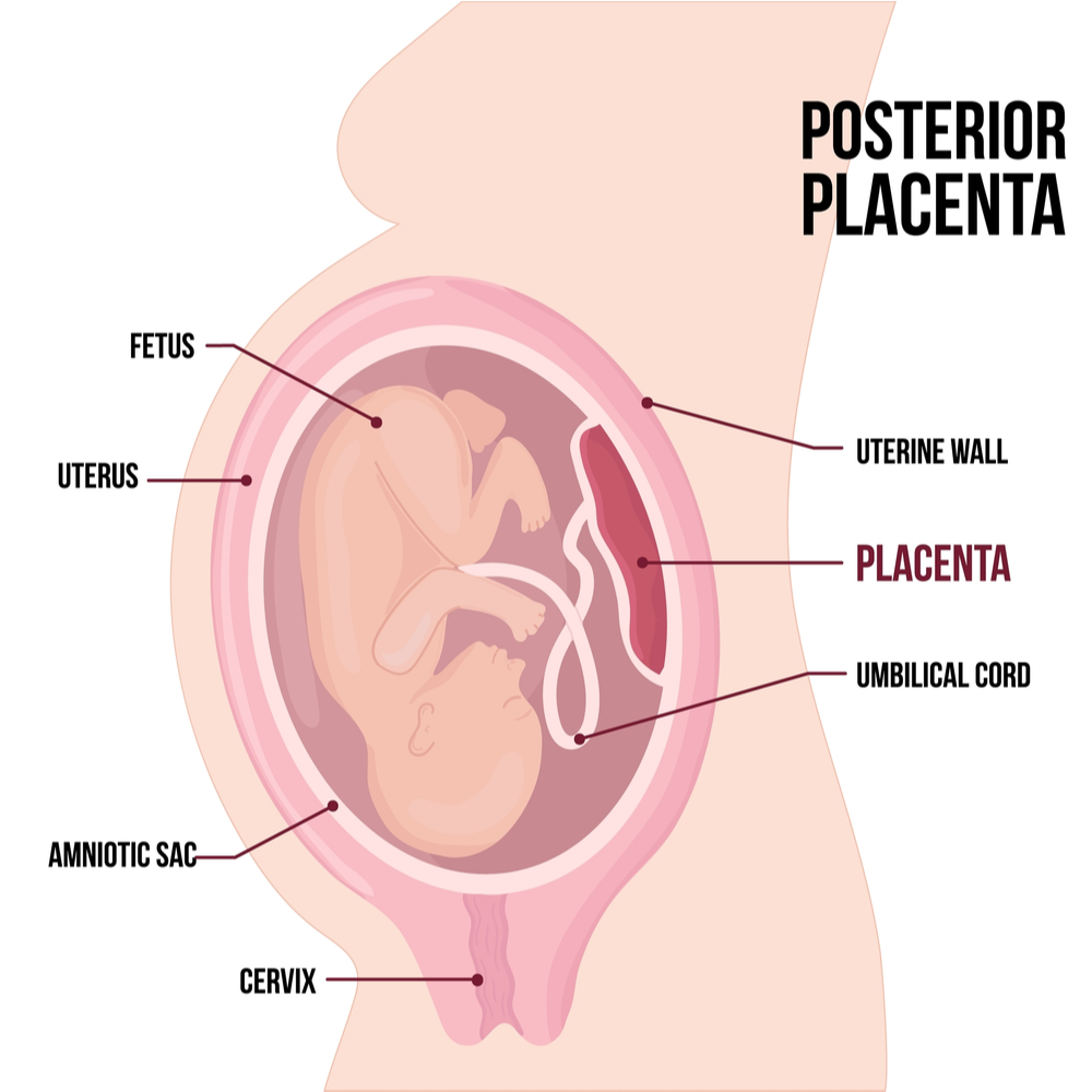 Placental Previa