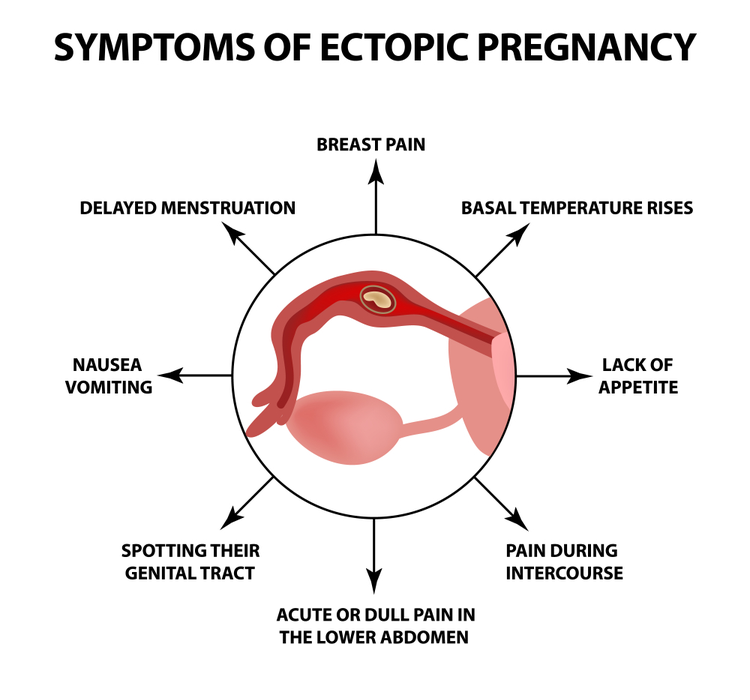 Symptoms Of Ectopic Pregnancy