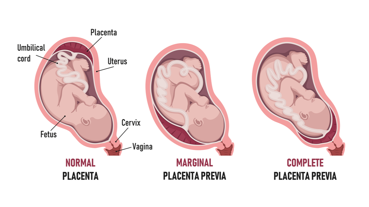 types of placenta previa