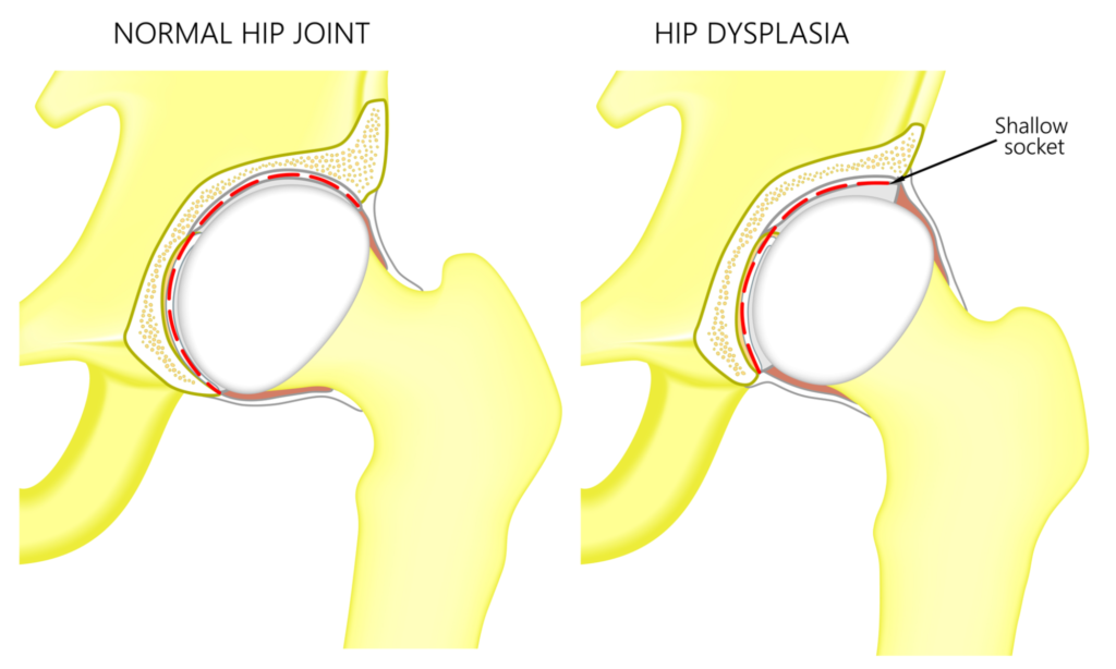 Hip Dysplasia in Children