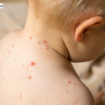 Measles in Children