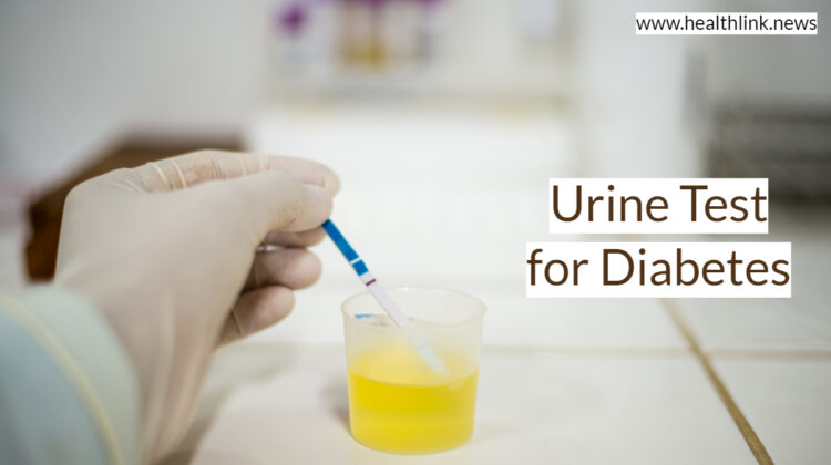 Urine Test for Diabetes or Glucose Levels