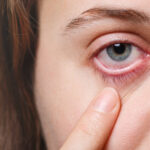 dry eyes, causes and treatment