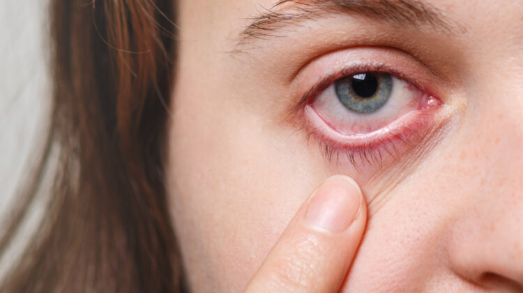dry eyes, causes and treatment