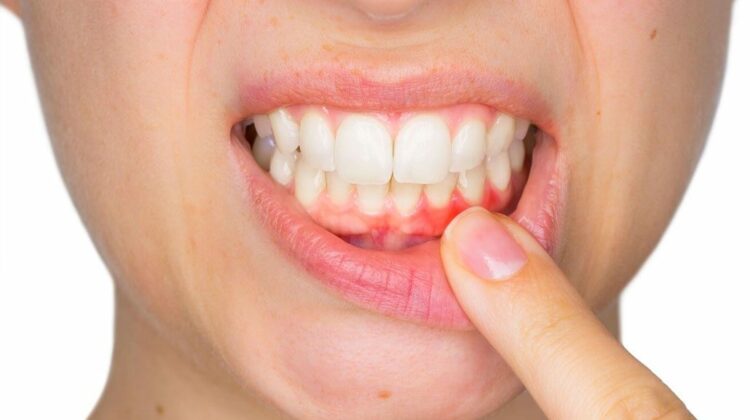 7 Home Remedies for Abscess Tooth