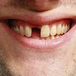 Most Common Causes of Tooth Loss