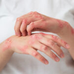 15 Ways to Get Relief from Hand Eczema