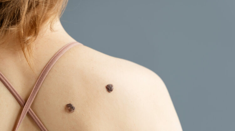 A Complete Guide To Identifying & Treating Moles, Freckles, and Skin Tags