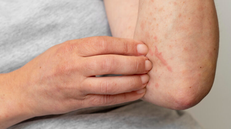 Eczema And Inflammation How to Cure it Permanently