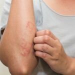 Eczema Symptoms, Causes, Effects and Its Prevention