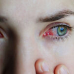 Conjunctivitis Symptoms, Causes, Diagnosis and Treatments