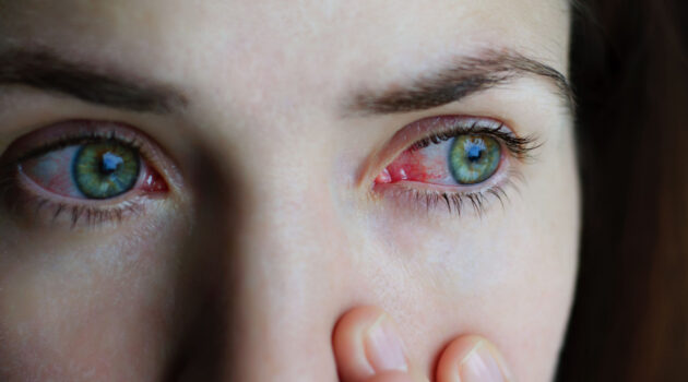 Conjunctivitis Symptoms, Causes, Diagnosis and Treatments