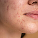 Cystic Acne: Types, Prevention and Treatment