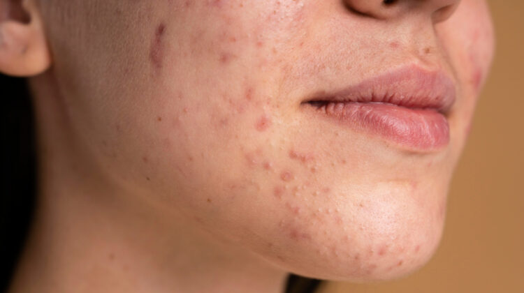Cystic Acne: Types, Prevention and Treatment