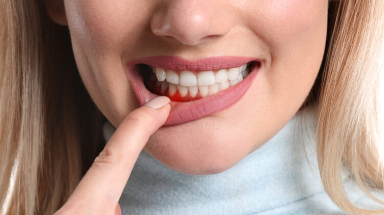Gum Disease Symptoms, Stages and Treatment Procedure