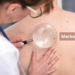 Merkel Cell Cancer Symptoms, Causes and Complications