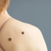 Skin Tags Causes, Precautions, Removal Methods
