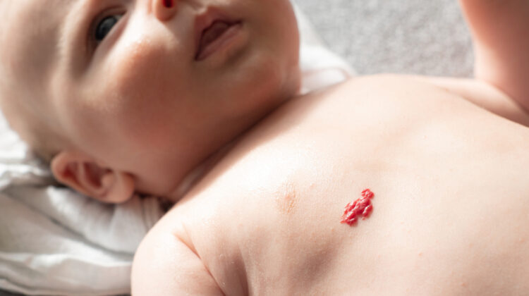 What Are the Causes of Birthmarks and How Do Affect Your Skin